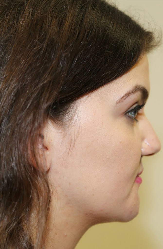 Chin Reduction — after (post-operative)